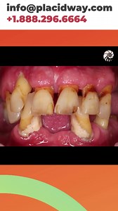 Smile Makeover in Tijuana, Mexico by Holistic Care using Ozone Therapy and Dentures #HolisticCare #SmileMakeoverTijuana #OzoneTherapy #Dentures | PlacidWay Medical Tourism