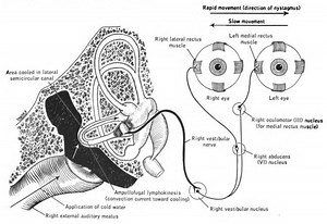 Caloric reflex test - Alchetron, The Free Social Encyclopedia