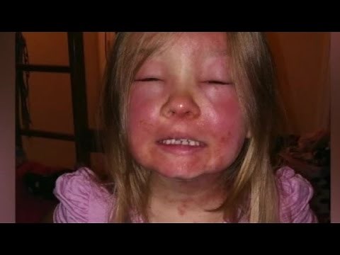 Girl gets bacterial infection after swimming in ocean