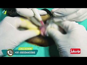 Penile Laser Frenuloplasty in Jaipur | Fast & Painless Treatment by Dr. Deepesh Goyal