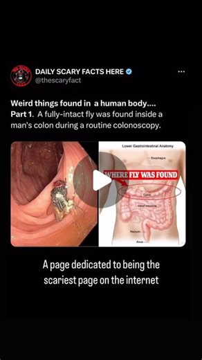 Thescaryfact ™ | The incident involving a fully-intact fly found inside a man’s colon occurred in 2019 and was reported by doctors from a hospital in India.... | Instagram