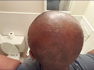 How To Cure Scalp Inflammation, Bumps and Blisters ( CCCA Alopecia/Folliculitis)