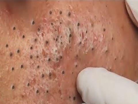 Tokyo Acne Treatment Blackhead Extractions Popping