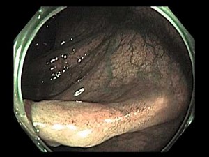 Scar After Resection of a Large Polyp • Video • MEDtube.net