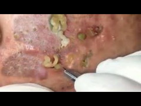 #15~Blackheads 2021 New • Blackhead • Nose Blackheads • Pimple Popping 2021 New Videos Blackheads