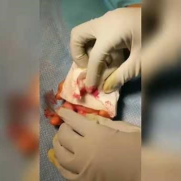 Hand abscess