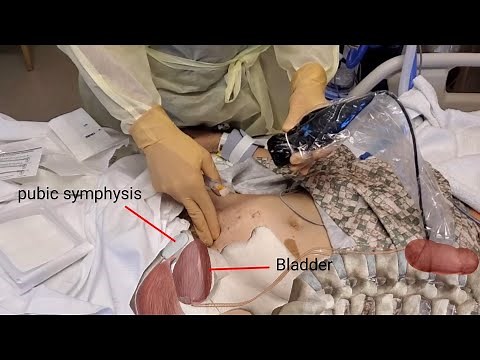 Ultrasound Guided Subrapubic Catheter