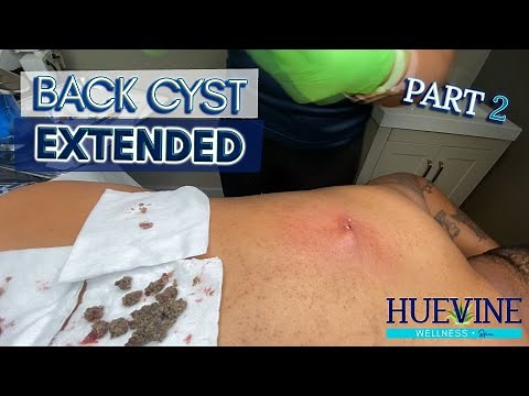 Part 2/3 Massive Back Cyst, Extended | HueVine