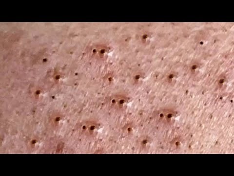 Acne Treatment with Anna Spa #005