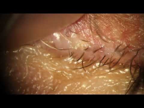 Popping Eyelid Cyst for 4 minutes