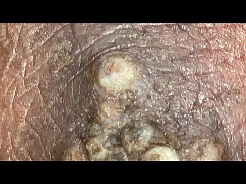 Javan’s whole jiggers removed - watch full video @https://riseupsociety.net