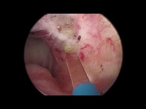 Enlarged Prostate Laser Surgery (HoLEP) by Dr Martin Elmes