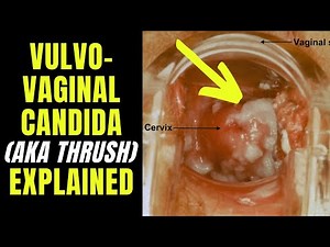 Doctor explains VULVOVAGINAL CANDIDIASIS (aka thrush) - including causes, symptoms & how to treat...