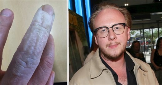 Štěpán Kozub má ošklivou popáleninu: Záchod, to je velký problém...