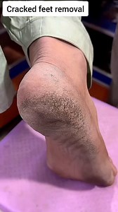 385K views · 4.1K reactions | Get rid of cracked heels | Fix cracked heels at home . . . #heels #heel #crackedheels #ridofcrackedheels #repaircrackedheels #feetcare #trendingreels #trending #viral #virals #fypシ゚ #explore #explorepage | Beauty recipes | Facebook