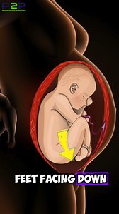 59K views · 764 reactions | A breech baby is positioned bottom-first,...