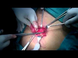 Part 1 - Umbilical Hernia - Purse string repair - Dr Narotam Dewan