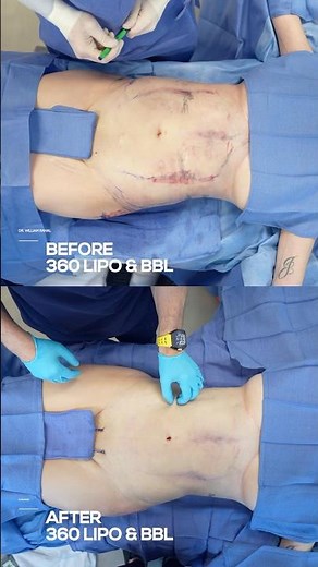 Hourglass Transformation: 360 Liposuction & Brazilian Butt Lift (BBL) Before And After!