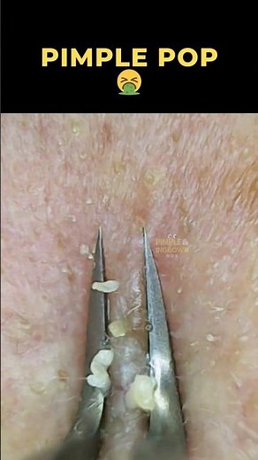 Insane Pimple Pop You Won’t Believe 👀✨