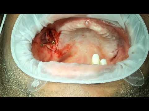 Part-1 Anatomic and IOPA guided precise pterygoid implant surgery by Dr. c. Murugavel