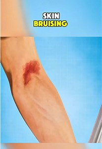 |Ever wondered why some bruises appear quickly while others take longer to show up?| #SkinBruising #BruiseHealing #BruiseCare #BruiseTreatment #InjuryRecovery