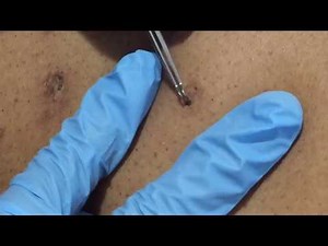 Episode 4 EXTRACTIONS!!!!!