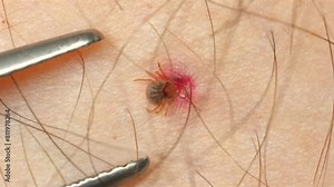 Close-up of tick embedded in human skin being removed with tweezers, highlighting importance of prompt parasite removal for disease prevention. Safety and health care.