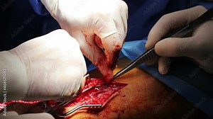 Closeup doctor in medical gloves stitching a wound on patient skin after surgical operation. Heart surgery. Hospitals. Medical, clinic. Healthcare.