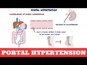 Portal Hypertension