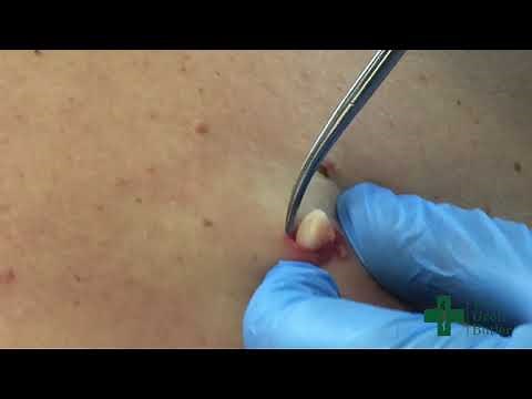Removal of an Epidermal Cyst along the midback