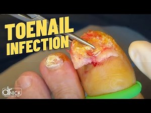 Extreme Ingrown Toenail Removal (Don’t Watch If You’re Squeamish)