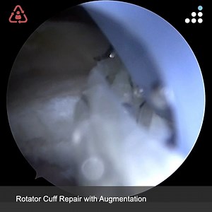 Here is an intra-op video of yesterday's case by Dr. Raffy Mirzayan....
