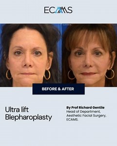 IN JUST 3 WEEKS! We will be having our next Bleph, Face and Neck Lift by Prof Richard Gentile! Watch another of his #transformations done to perfection! Another happy patient that he has impacted! We are opening our last 2 seats for our next bleh, face and neck lift training! Do contact us to book your seat today! info@ecamedicine.com | +353 86 804 8992 #ecams #ecamstraining #face #aesthetics #training #cme #cpd | ECAMS European College of Aesthetic Medicine & Surgery | Facebook