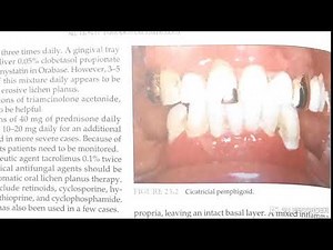 Desquamative gingivitis
