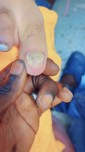 Nail Care Techniques for Discolored Toenails