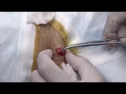 Large Epidermoid Cyst Removal! Cysts, Whiteheads, Dermatolgy Videos