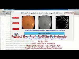 Diabetic Retinopathy Detection Using Image Processing | Matlab Final Year IEEE Project Code