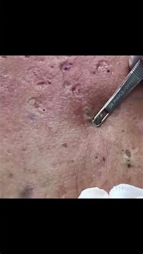The kind of blackheads everyone wants to see
