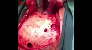 BRAIN HEMORRHAGE SURGERY IS PRETTY DAMN INTERESTING