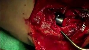 Evolve Proline Radial Head Replacement Surgical Technique Video – Pre-op, Intra-op, and Post-op Considerations