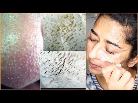 How to Instant Remove Blackheads and Facial Hair At Home || Indian Beauty Guru