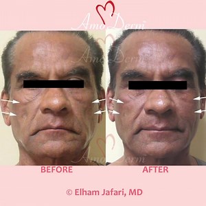  Cheek Restoration & Non-surgical facelift (Liquid Facelift) ____ ...