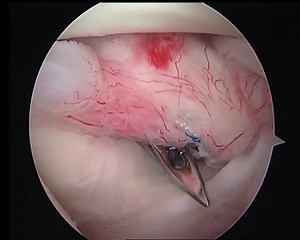 Video relive surgery 1