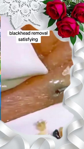 blackhead removal #pimplesatisfying #fy #satisfyingvideos