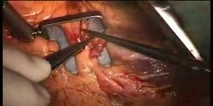 Heart Surgery Video
