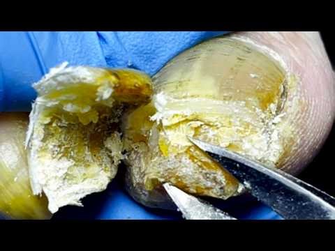 Long And Yellow Toenails, Remove Impurities【Pedicure Master Lin Jun】