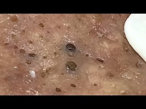 Blackheads & Whiteheads Satisfying Removal Acne and Pimple @07944