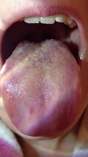red bumps on back of tongue
