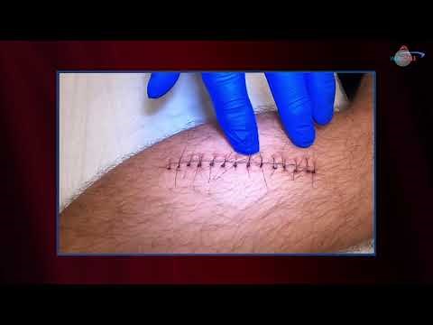 WCW: Removing Sutures from a Leg Laceration