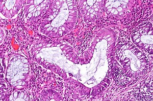 How does estrogen increase the risk of autoimmunity for women? | Immunology